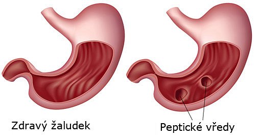 zdravy-vredy-zaludek-jpg_denik-630
